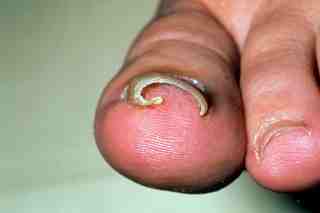 Why Do Toenails Grow Inside the Skin