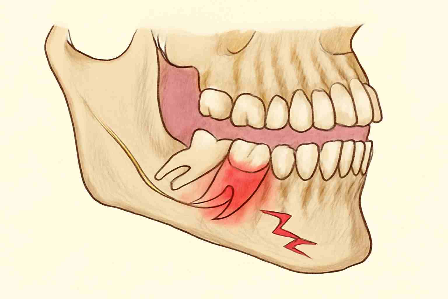 wisdom-teeth-history-pain-reason